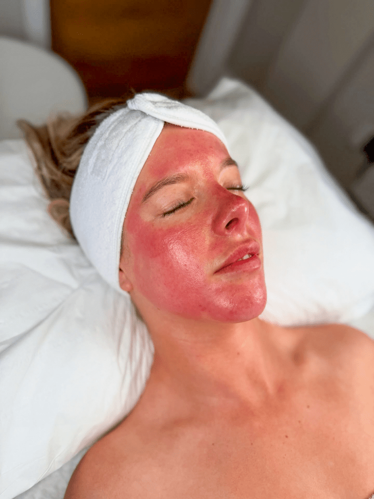 Mikroadatinė procedūra , IG @_skinkind | Treatwell