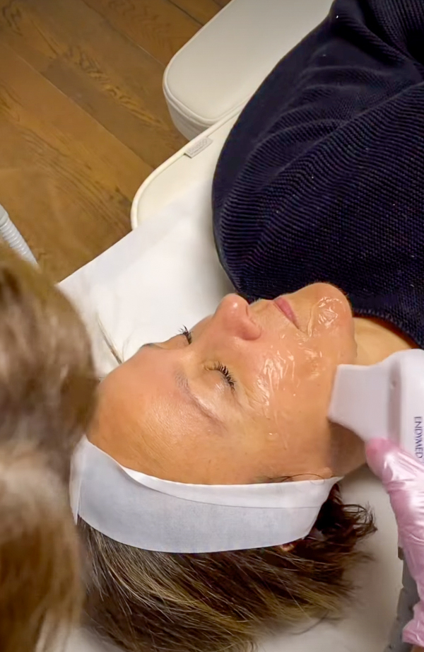 Radijo dažnių procedūra veidui, IG @sadaf_jaffari | Treatwell